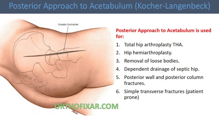 Posterior Approach to Acetabulum