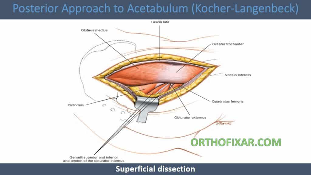 Posterior Approach to Acetabulum