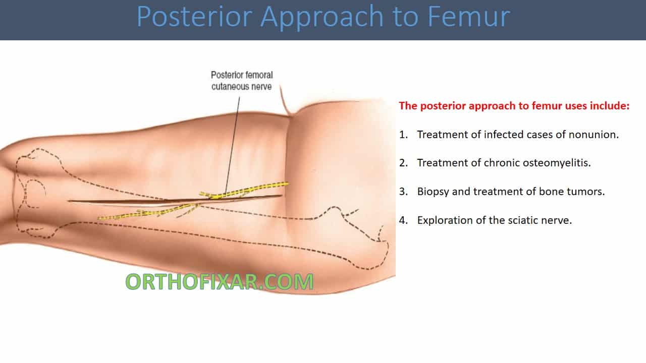  Posterior Approach to Femur 