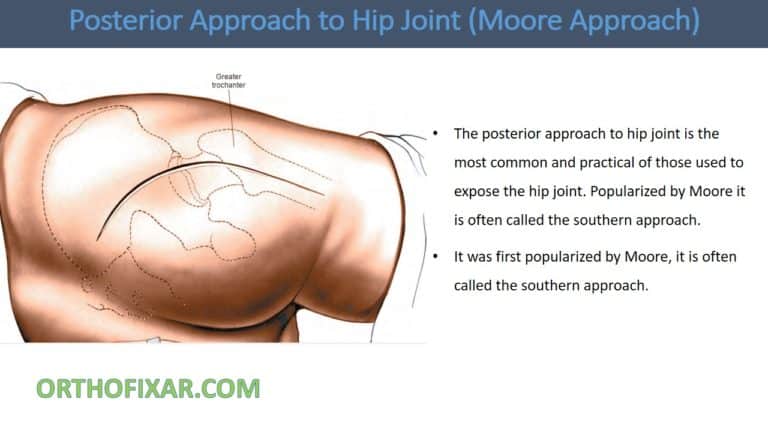 Posterior Approach to Hip Joint (Moore Approach)