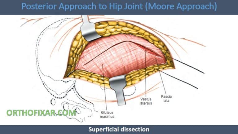 Posterior Approach To Hip • Easy & Full Tutorial • OrthoFixar 2026