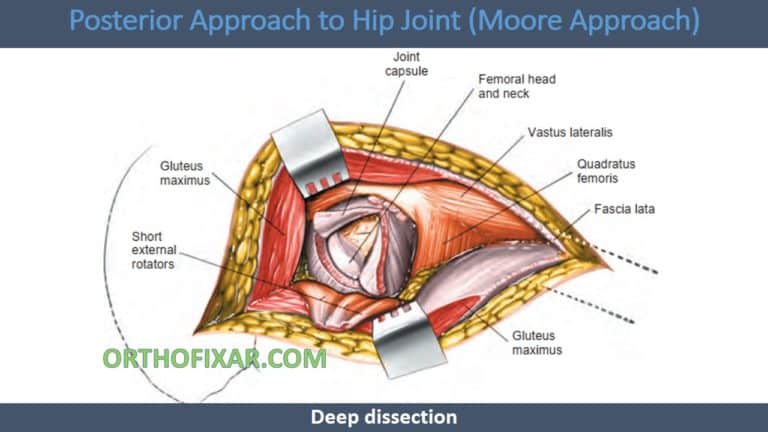 Moore Approach Posterior Approach To Hip Replacement: Anatomy, Steps, And Dangers