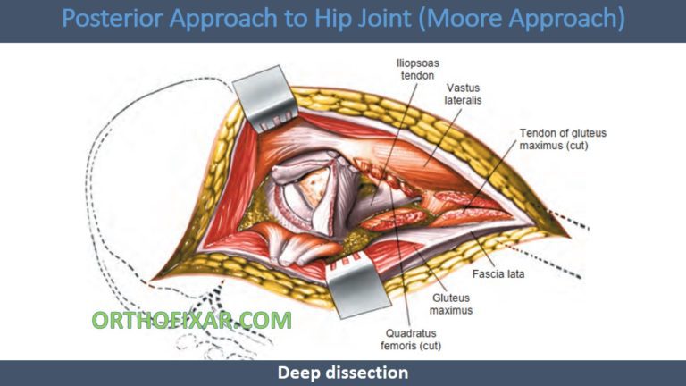 Moore Approach Posterior Approach To Hip Replacement: Anatomy, Steps, And Dangers