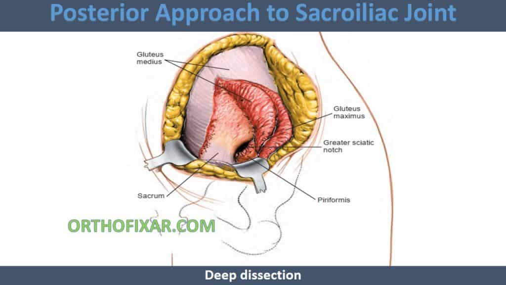 Posterior Approach to Sacroiliac Joint