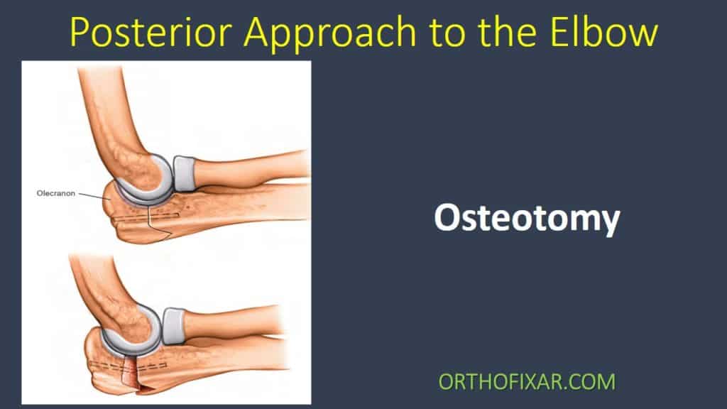 Posterior Approach to the Elbow