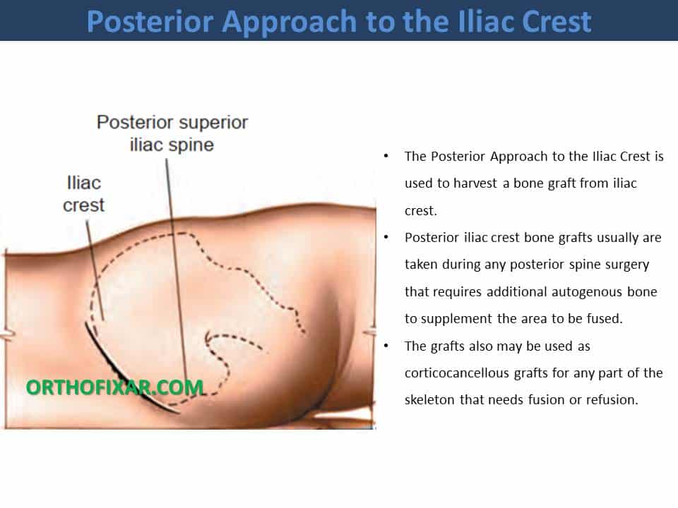  Posterior Approach to the Iliac Crest 