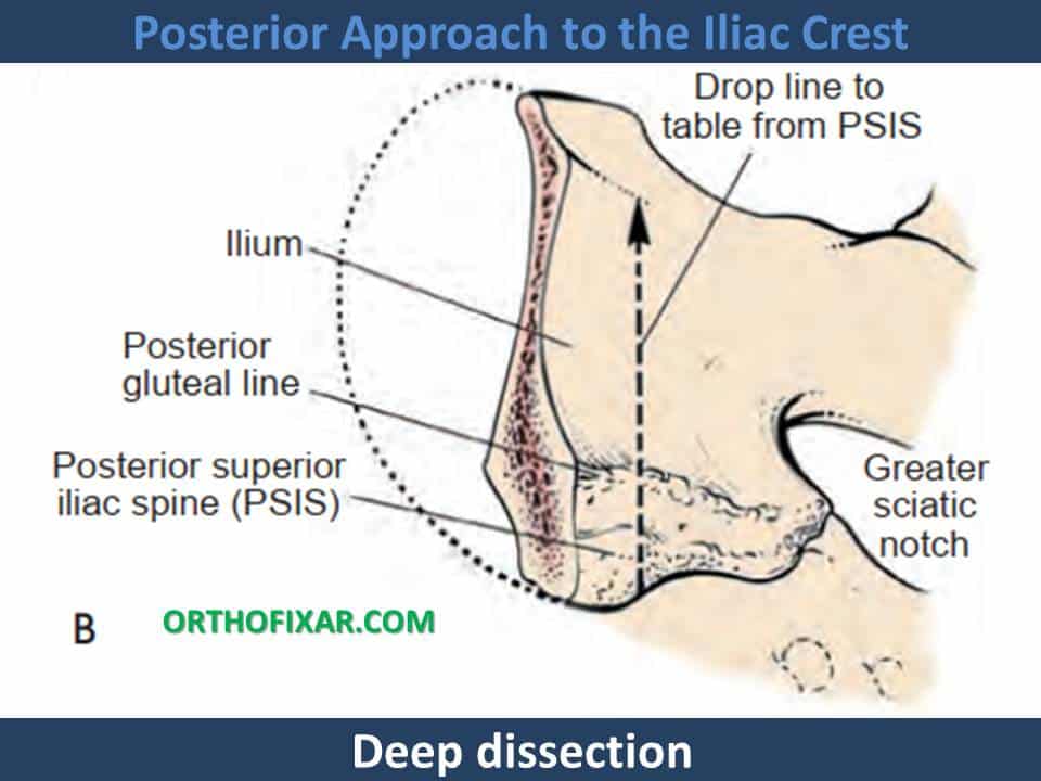 Posterior Approach to the Iliac Crest