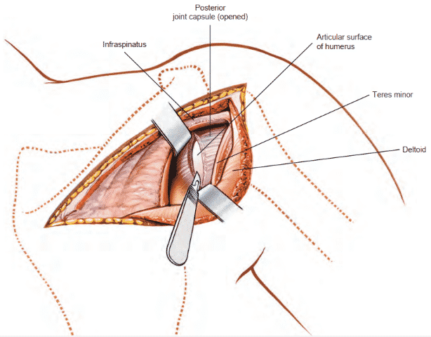 Posterior Approach to the shoulder
