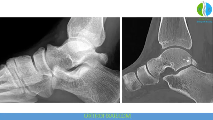 Posterior Process Fracture