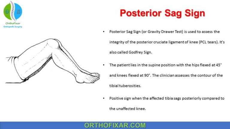 Posterior Sag Sign