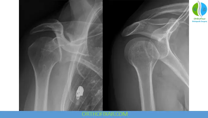 Posterior Shoulder Dislocations 3 Posterior Shoulder Dislocations xray