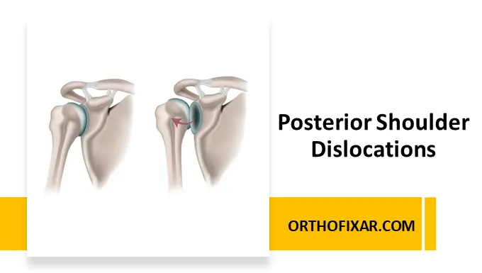 Posterior Shoulder Dislocations