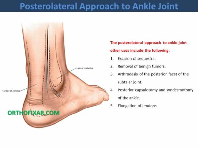 Posterolateral Approach to Ankle Joint