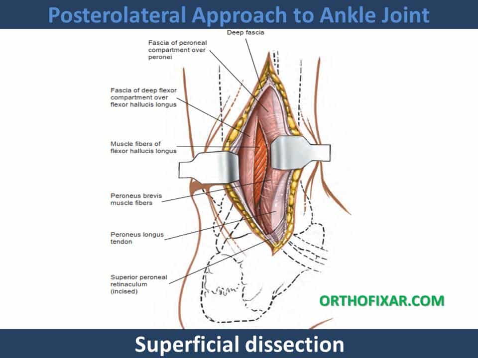 Posterolateral Approach to Ankle Joint