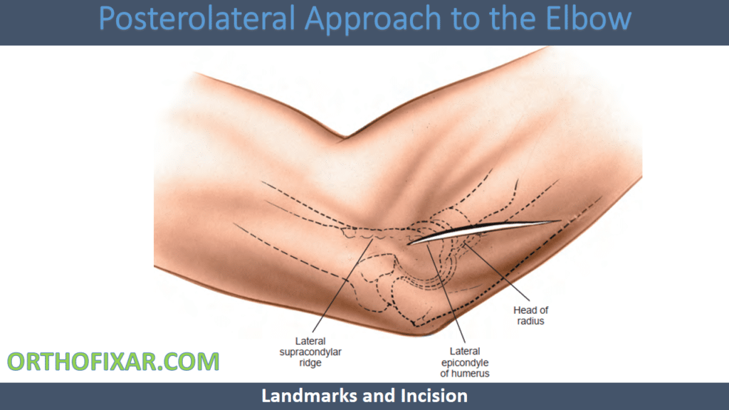 Posterolateral Approach to the Elbow