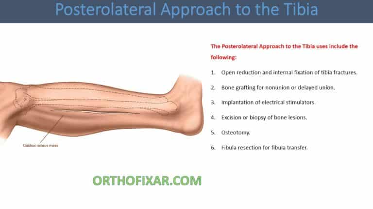 Posterolateral Approach to the Tibia