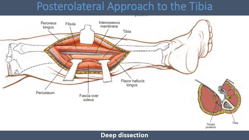 Posterolateral Approach to the Tibia