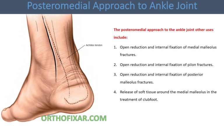 Posteromedial Approach to Ankle Joint