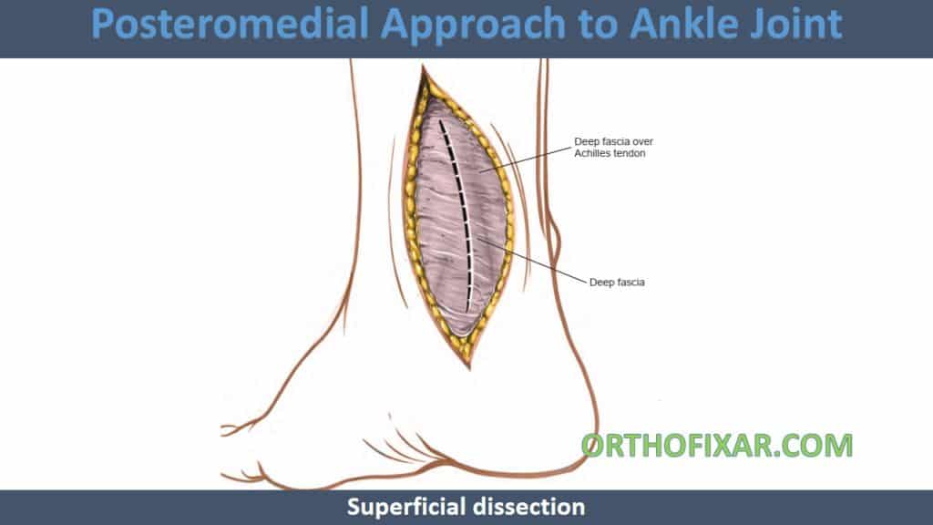 Posteromedial Approach to Ankle Joint