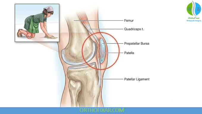 Prepatellar Bursitis - housemaid knee