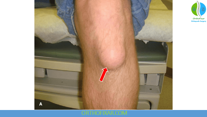 Prepatellar Bursitis