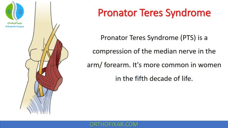 Pronator Teres Syndrome