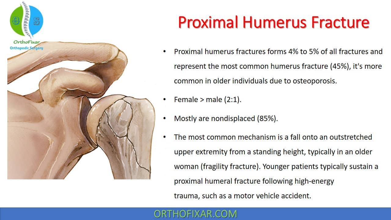 Proximal Humeral Fracture Classification