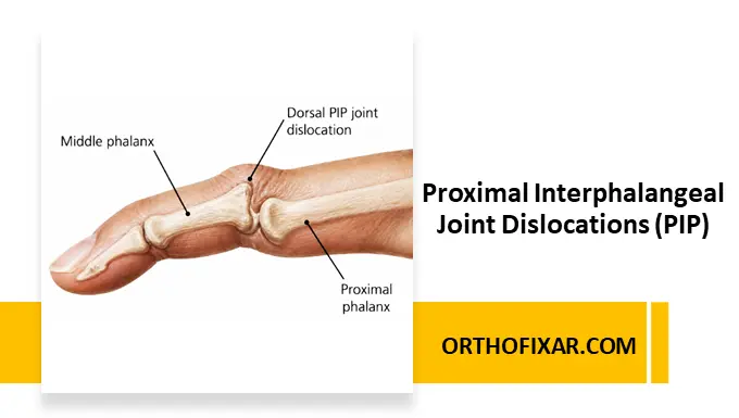 Proximal Interphalangeal Joint Dislocation