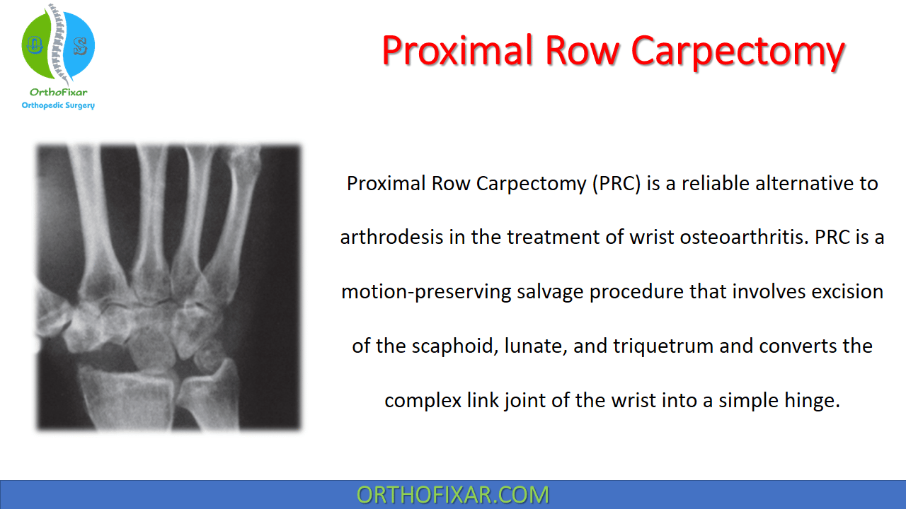  Proximal Row Carpectomy 