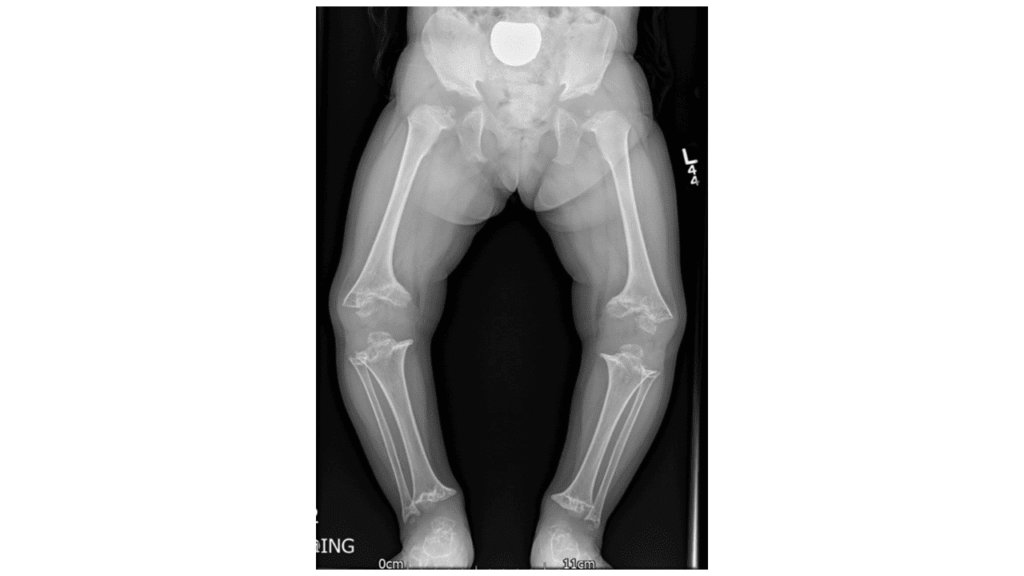 Pseudoachondroplasia: Causes, Clinical Features, Diagnosis & Management 3 Pseudoachondroplasia xray