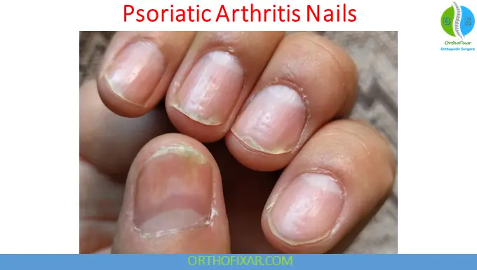 Psoriatic Arthritis: Symptoms, Causes, Diagnosis & Treatment 5 Psoriatic Arthritis Nails