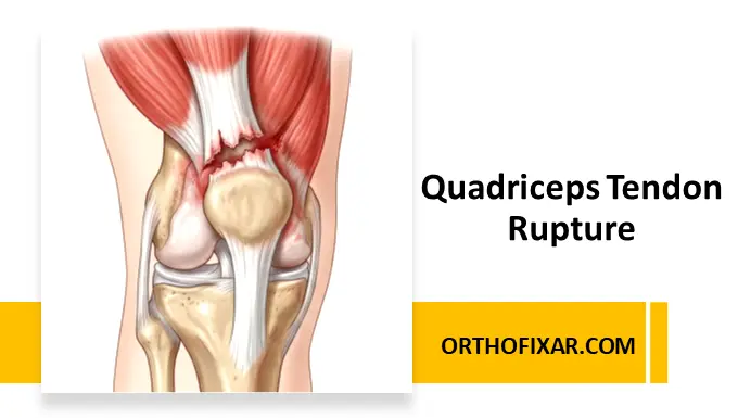 Quadriceps Tendon Rupture