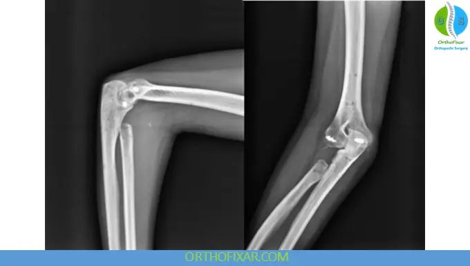 Radial Head Excision