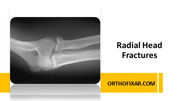Radial Head Fracture