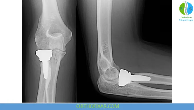 Radial Head Replacement