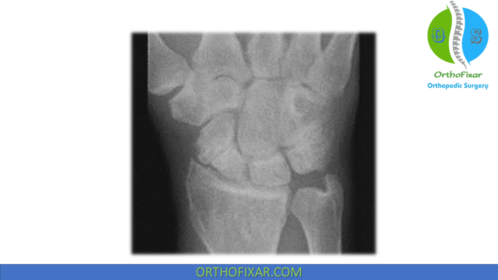 Radiocarpal arthritis