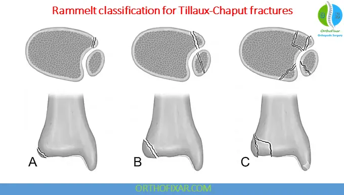 Rammelt classification for Tillaux-Chaput fractures 