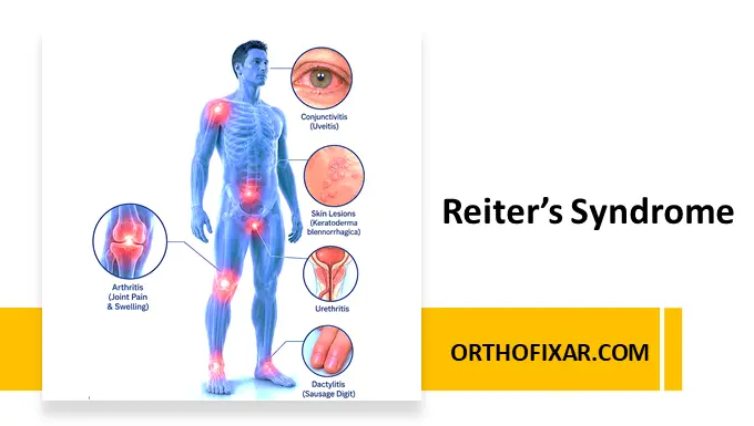 Reiter's syndrome