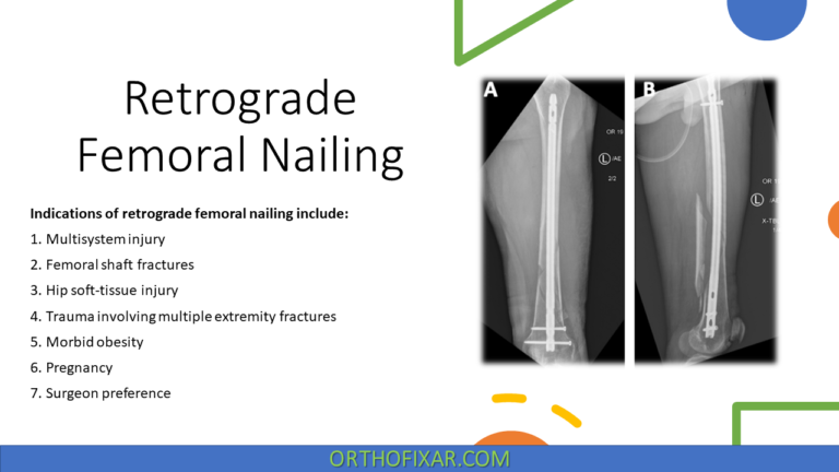 Retrograde Femoral Nailing