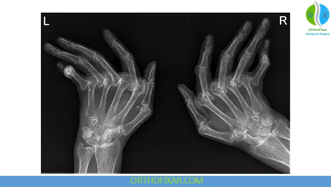 Rheumatoid Arthritis (RA): Causes, Symptoms, Diagnosis & Treatment 7 Rheumatoid Arthritis xray of the hand