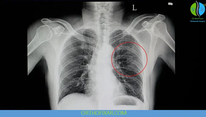 Rib Fractures xray