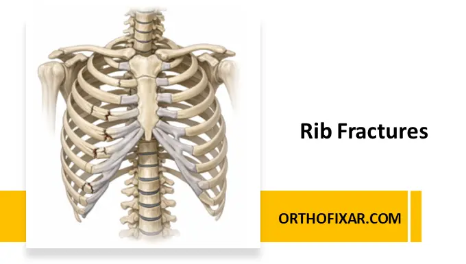 Rib Fractures
