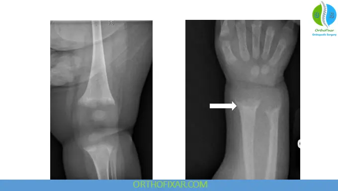 Rickets Definition, Symptoms, Causes, Types, Diagnosis & Treatment 5 Rickets Metaphyseal cupping