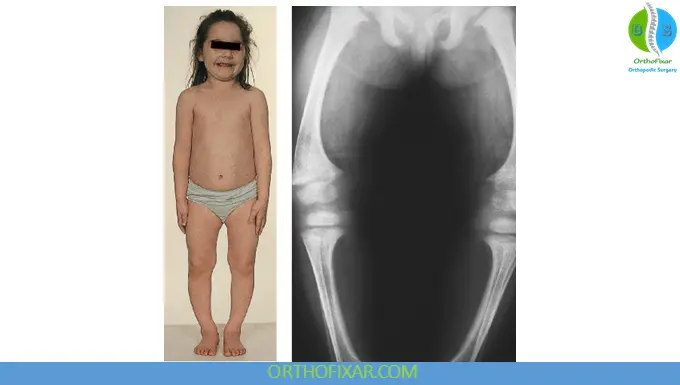 Rickets Definition, Symptoms, Causes, Types, Diagnosis & Treatment 4 Rickets