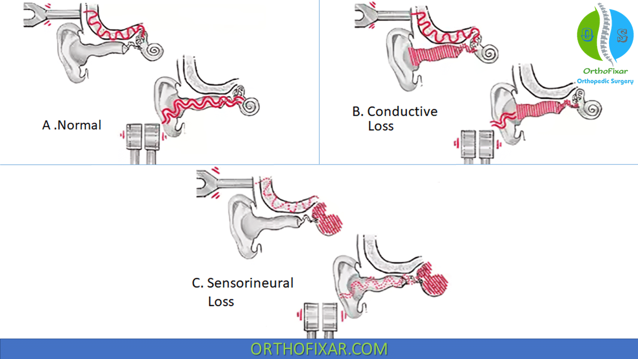 Rinne Test Interpretation For Conductive Hearing Loss OrthoFixar 2024