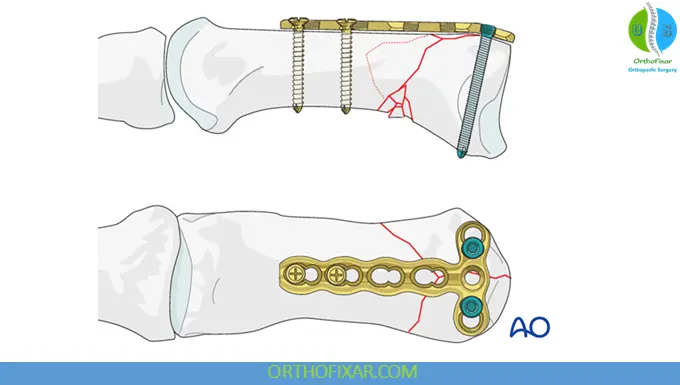 Rolando Fracture fixation