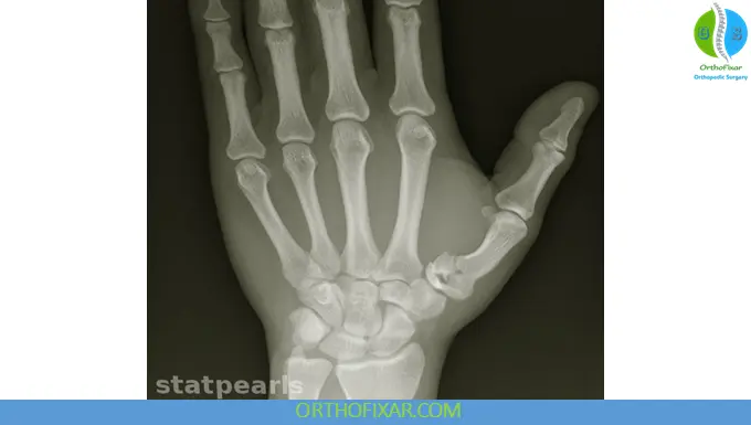 Rolando Fracture xray