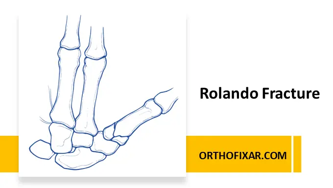Rolando Fracture