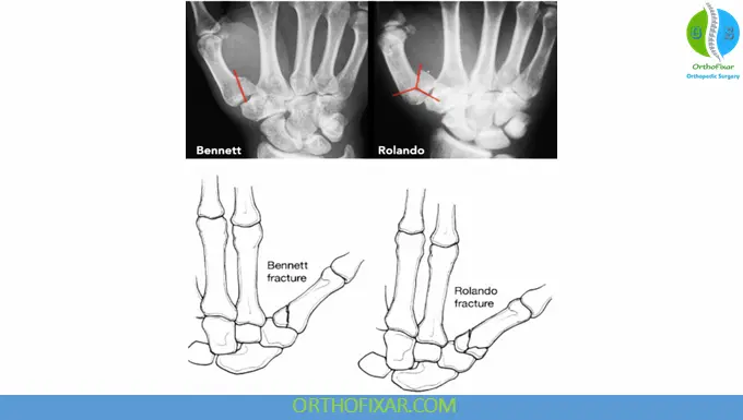 Rolando vs Bennett Fracture