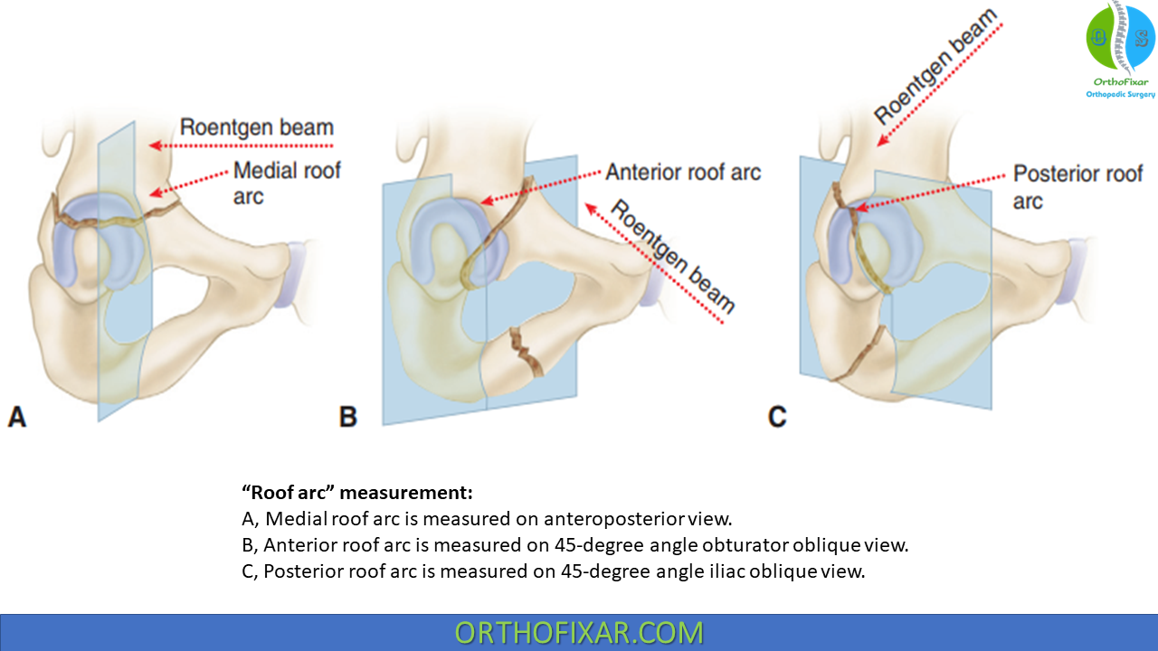 Acetabulum Fracture: Anatomy, Classification, And Treatment